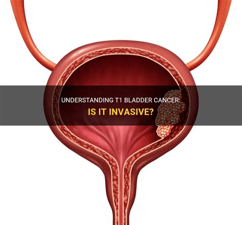 Understanding T1 Bladder Cancer Is It Invasive Medshun