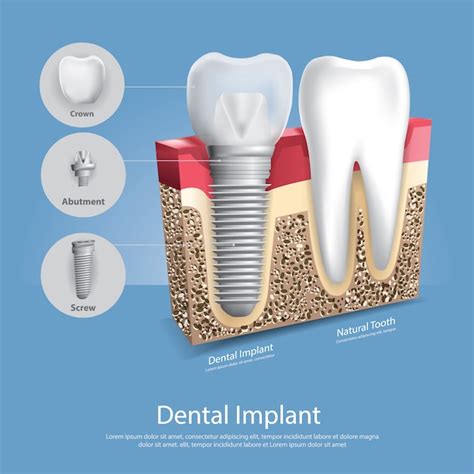 Premium Vector Human Teeth And Dental Implant Vector Illustration