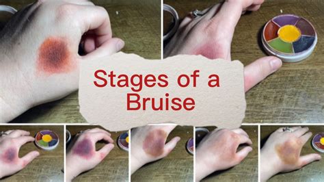 Stages of a Bruise : r/zombies