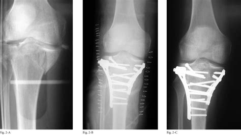 Figure 2 From Open Reduction And Internal Fixation Vs A Circular