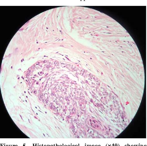 Desmoplastic Ameloblastoma Histology