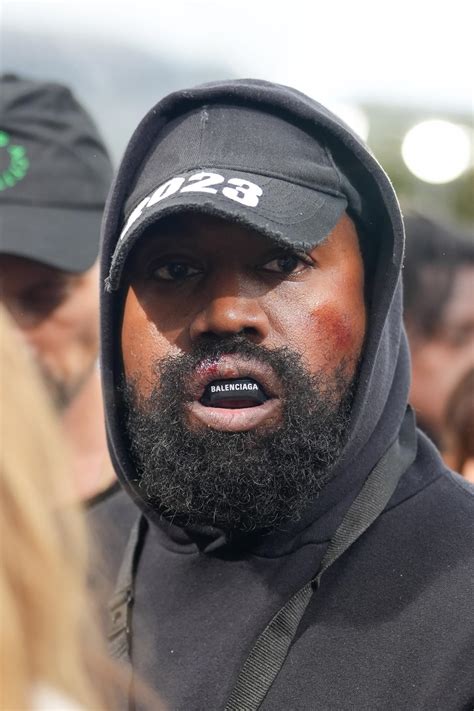 Kanye West shocks fans with bloody lip and bruises as he wears mouth