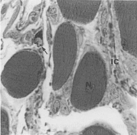 Micrograph Showing Dystrophic Masseter Muscle Centrally Located Muscle