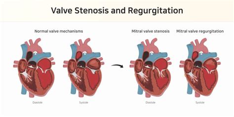 Valvular Heart Disease What Are The Different Types Pulse Cardiology