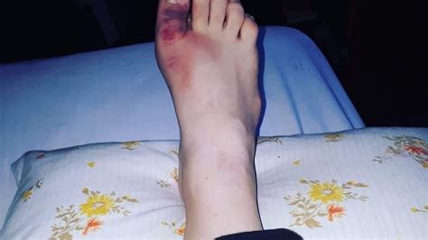 Une Fracture De Pied Diagnostiqu E Tardivement M Ne Lamputation