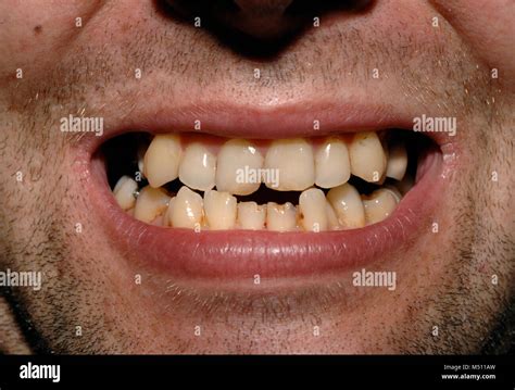 Uneven Teeth Immagini E Fotografie Stock Ad Alta Risoluzione Alamy