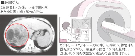 癌 Ct検査 造影剤 Hello Doctor