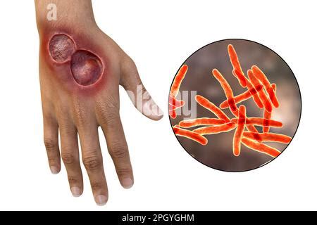 Illustration Of A Buruli Ulcer On A Hand With A Close Up View Of