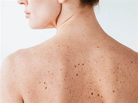 Enlever les grains de beauté au laser à Paris Dermatologue esthétique