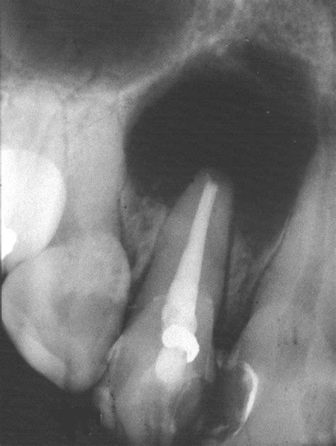 Radicular Cyst Radiology