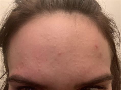 Fungal or bacterial acne? : r/Fungalacne