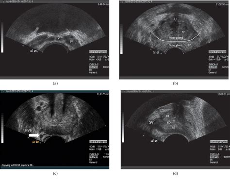 Figure From Applications Of Transrectal Ultrasound In Prostate Cancer