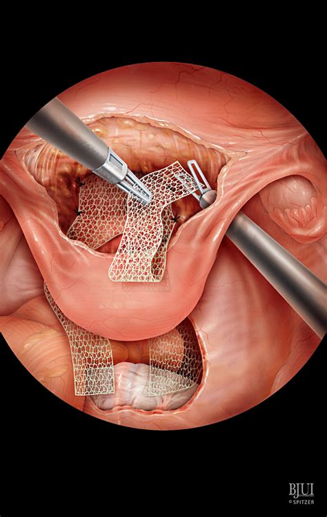 Laparoscopic Sacrocolpopexy Gaston 2011 Bju International Wiley