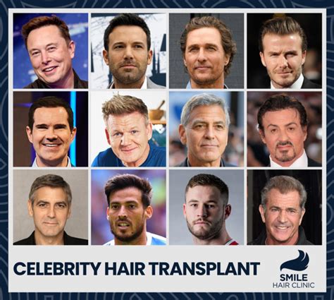 Gordon Ramsay Before And After Hair Transplant