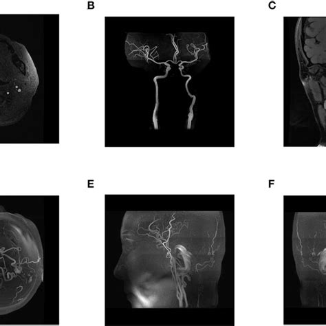 AF Postoperative Head And Neck MRA Three Dimensional Reconstruction