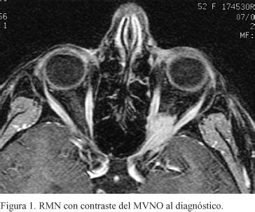 Observatorio Aut Mata Met Fora Calcificacion Nervio Optico Elasticidad