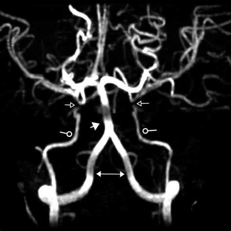 Magnetic Resonance Angiography Showing Occlusion Open Arrow Heads Of