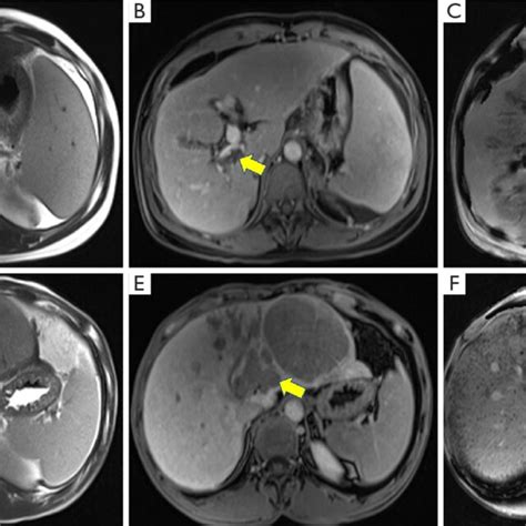 (A-C) Benign PVT in a 40-year-old woman. PVT (yellow arrow) appears ...