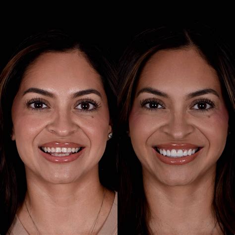 Gallery Before And After Dental Veneers In Los Angeles Ca Smiles By