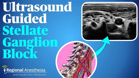 Ultrasound Guided Stellate Ganglion Block