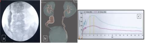 Application Of The Yang Monti Principle” In Children With Iatrogenic