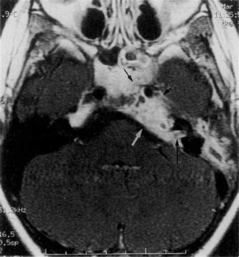 Figure 2 from Chronic Petrous Apicitis with Pericarotid Extension into ...