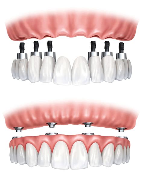 Orofacial 32 Implantes Dentários Alguns Conceitos Básicos Orofacial