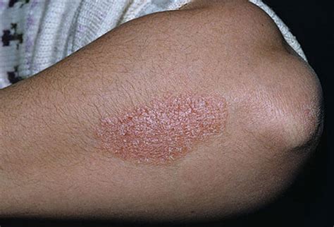 Dry And Bumpy Skin On Your Arms Causes And Treatments New Health Advisor