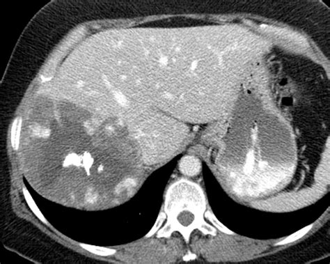 Liver Atlas: Case 75: Hemangioma