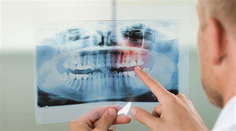 Qué es una radiografía periapical y cuándo se realiza Estudi Dental