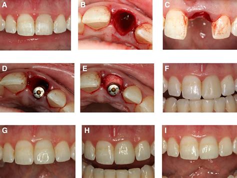 Immediate Implant Placement And Restoration In The Anterior Maxilla