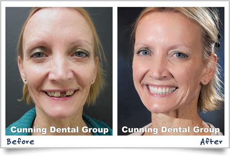 Cunning Dental Group Smile Gallery