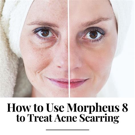 How To Use Morpheus To Treat Acne Scarring