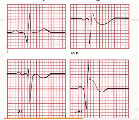 EKG Exam 3: Acute MI Changes Flashcards | Quizlet