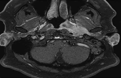 Petrous Apicitis: A Systematic Review and Case Presentation : Otology ...