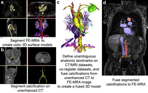 Intermodality Feature Fusion Combining Unenhanced Computed Tomography