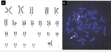 Genetic Testing Of The Patient A Chromosome Analysis Showing A Normal Download Scientific