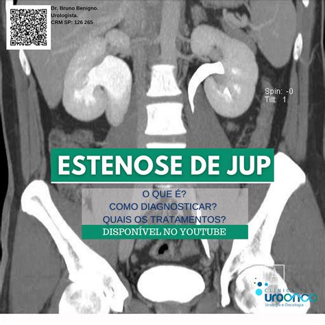 Estenose De Jup O Que Sintomas E Tratamentos