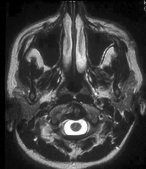 9 Radiologic Evaluation Of Vascular Malformations Ento Key