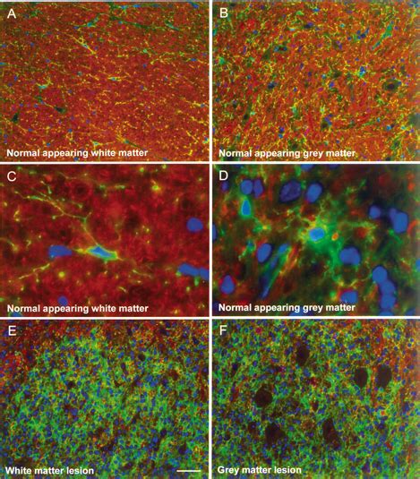 Remyelination In Mog Eae The Presence Of Oligodendrocyte Remyelination