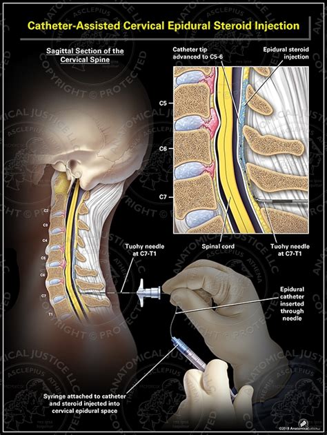 Catheter-Assisted Cervical Epidural Steroid Injection