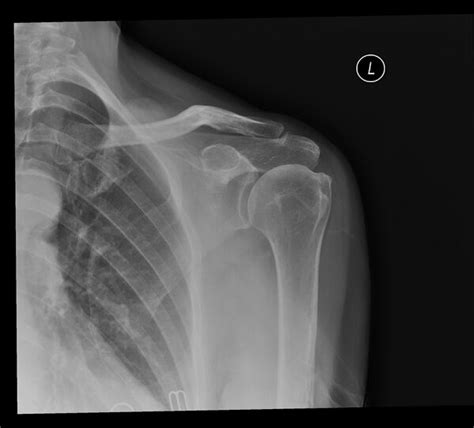 Acromioclavicular Arthritis - Physiopedia