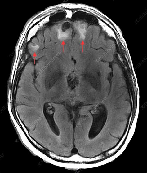 Chronic Post-Traumatic Brain Injury, MRI - Stock Image - C030/6070 ...