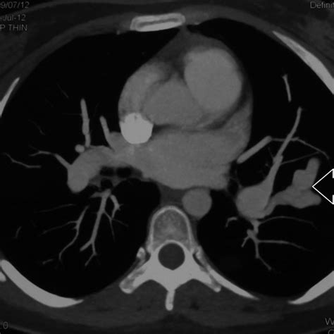 E A Ct Pulmonary Angiogram Ctpa At Presentation Shows A Large