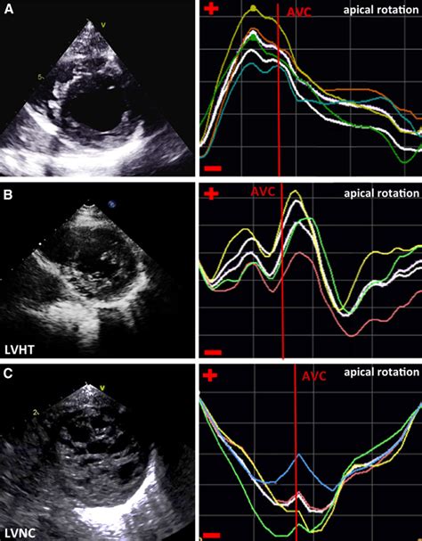 Left Ventricular Twist Mechanics To Identify Left Ventricular