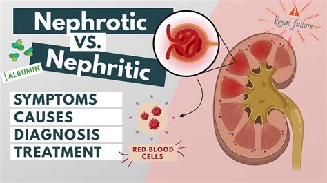 Nephrotic vs. Nephritic syndrome | Symptoms, diagnosis, causes ...