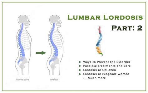 Lordosis Treatment Before After