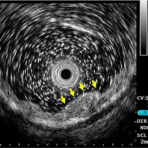 On Endoscopic Ultrasonography The Tumor Presents As A Hypoechoic Download Scientific Diagram