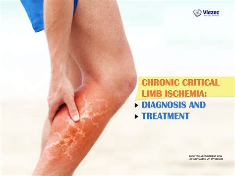 Chronic Critical Limb Ischemia: Diagnosis And Treatment