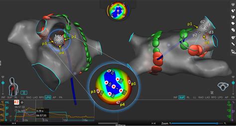 Lattice Tip Focal Ablation Catheter That Toggles Between Radiofrequency